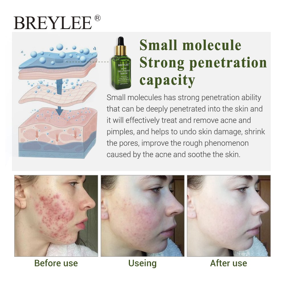 Avelion - Targeted Acne Control Serum