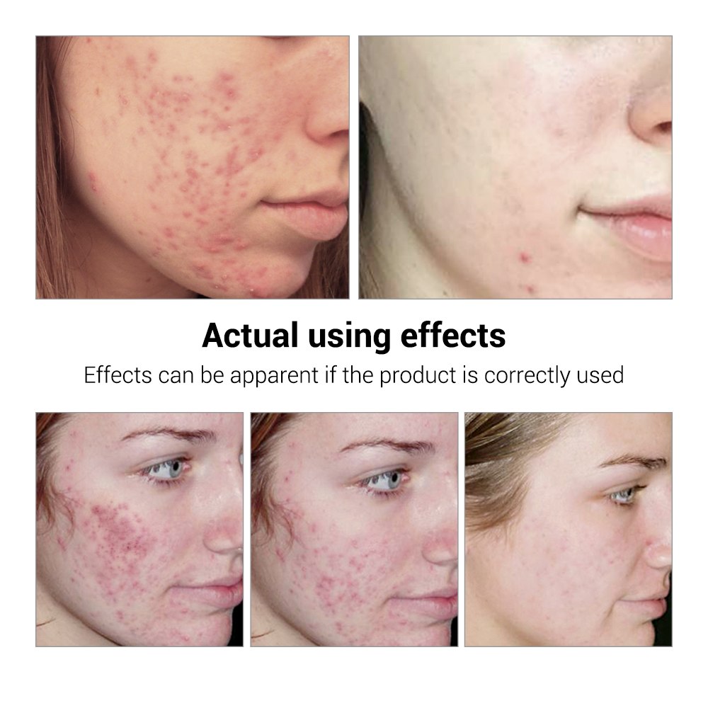 Avelion - Targeted Acne Control Serum